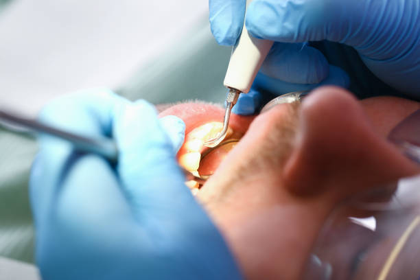 Best Emergency Wisdom Teeth Removal in Riddle, OR